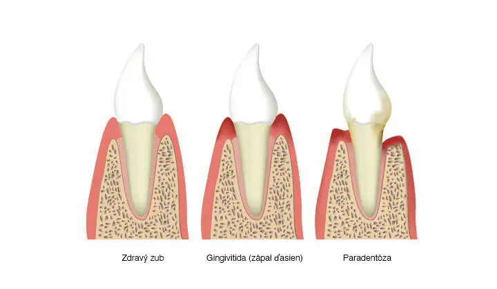 Parodontitída spôsobená zápalom ďasien