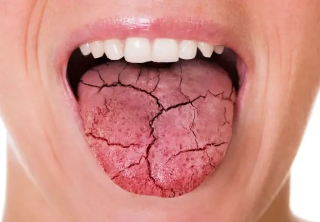 Sucho v ústach & ako ho liečiť